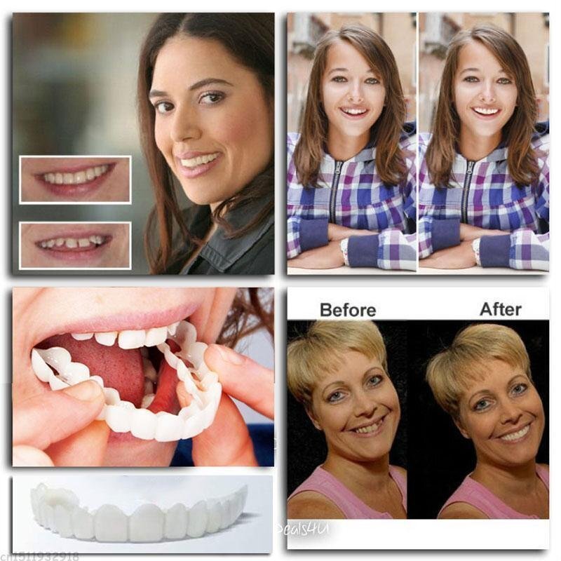🎉Last Days 58%OFF 🎉Snap-On Dentures